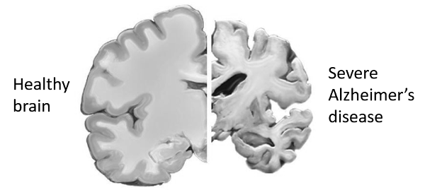 alzheimers brain